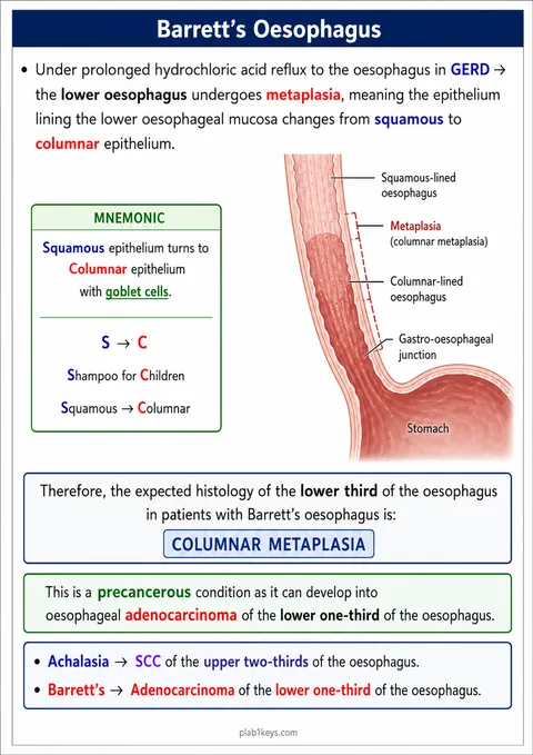 PLAB 1 and UKMLA chapter content preview: Barrett’s Oesophagus
